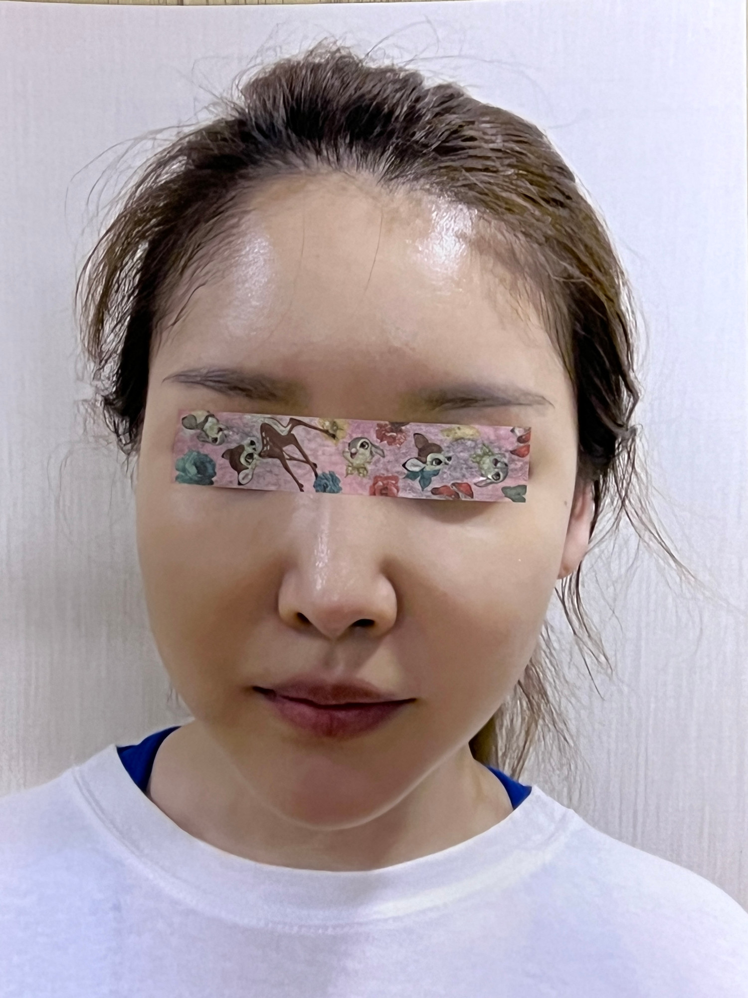 CASE 01 시술 전