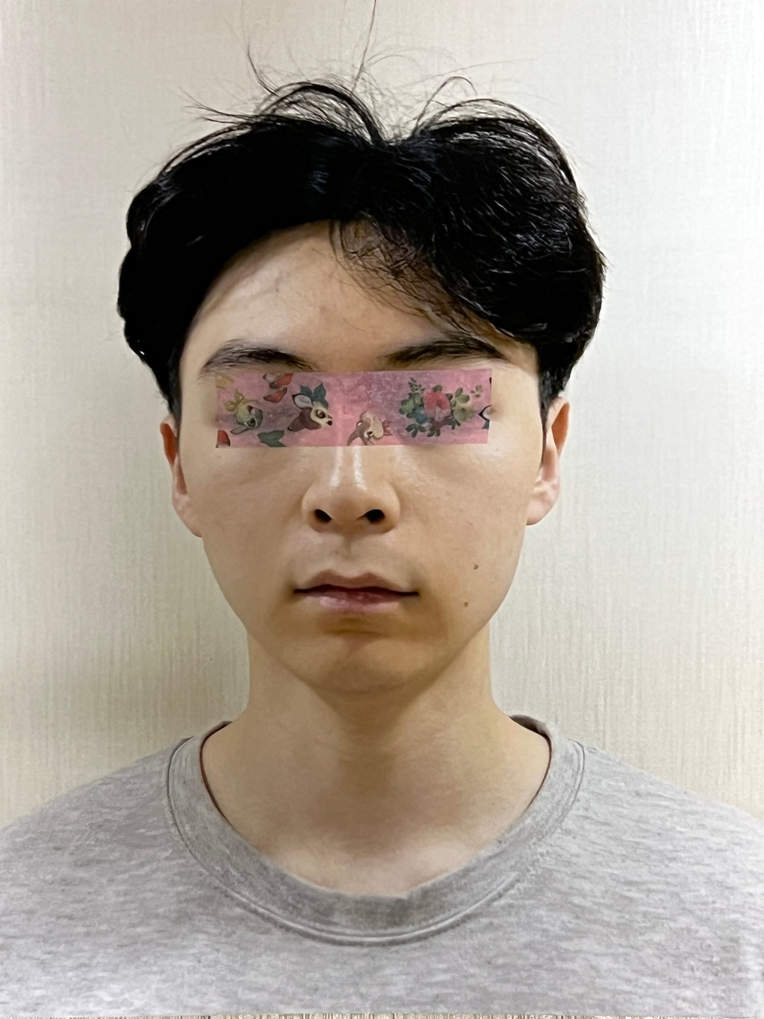 CASE 03 시술 후